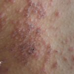 Close-up of skin rash from waterborne bacteria. Red, inflamed skin with small bumps and blisters. Skin irritation.