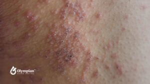 Close-up of skin rash from waterborne bacteria. Red, inflamed skin with small bumps and blisters. Skin irritation.