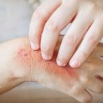 Hand with skin rash. Irritated skin, possibly from contaminated water exposure. Symptoms include redness and itchiness.