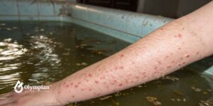 What bacteria commonly cause skin rashes from water exposure - Olympian ...
