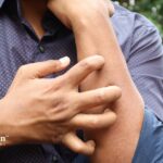 Skin irritation from well water. Person scratching arm, possibly due to fluoride or other contaminants in well water.